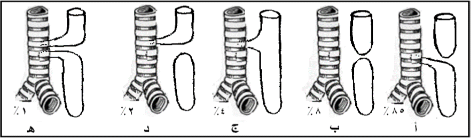 Common Congenital Anomalies in Newborns : - Esophageal Atresia (EA) and ...